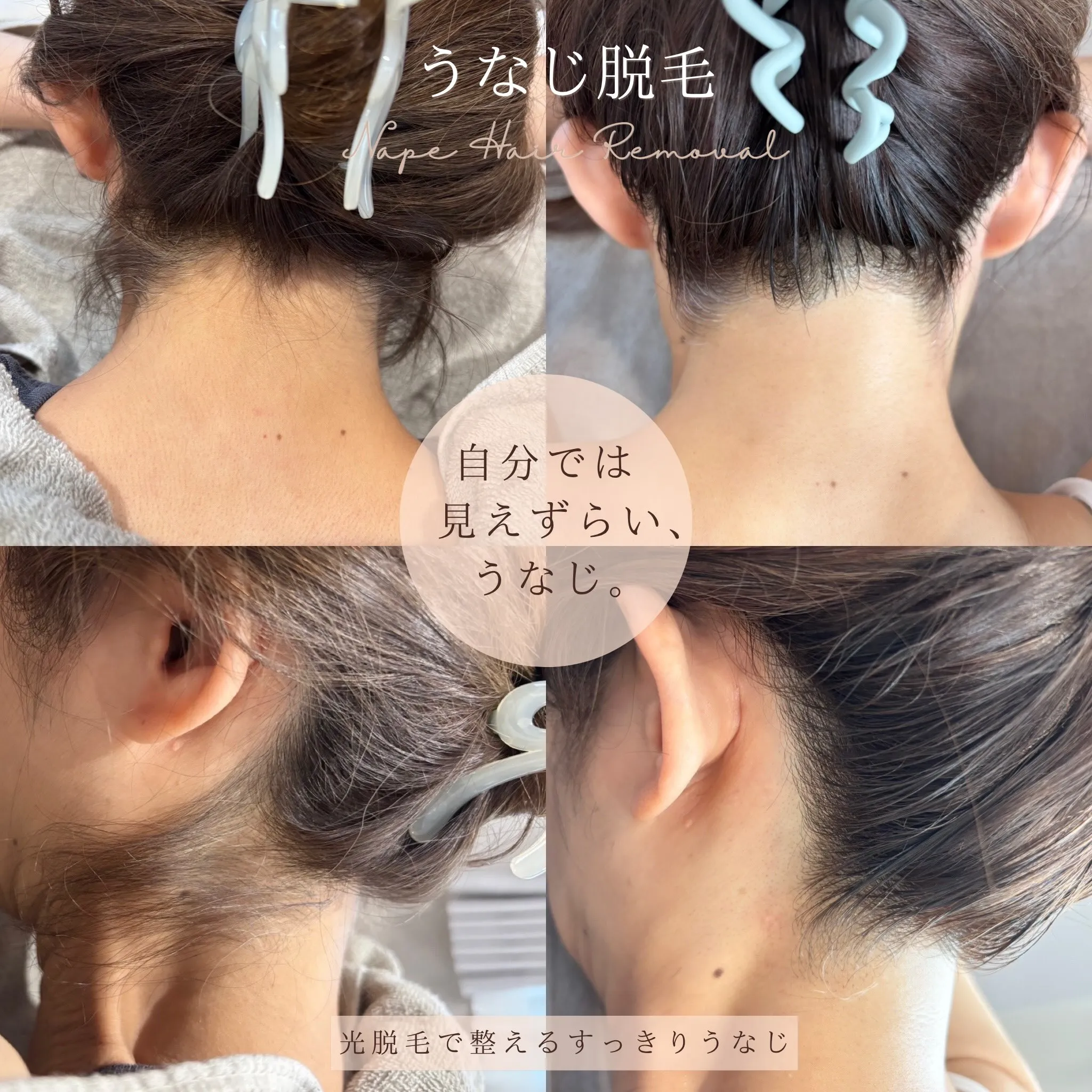 「うなじが気になって、髪を結ぶのに抵抗がありました」